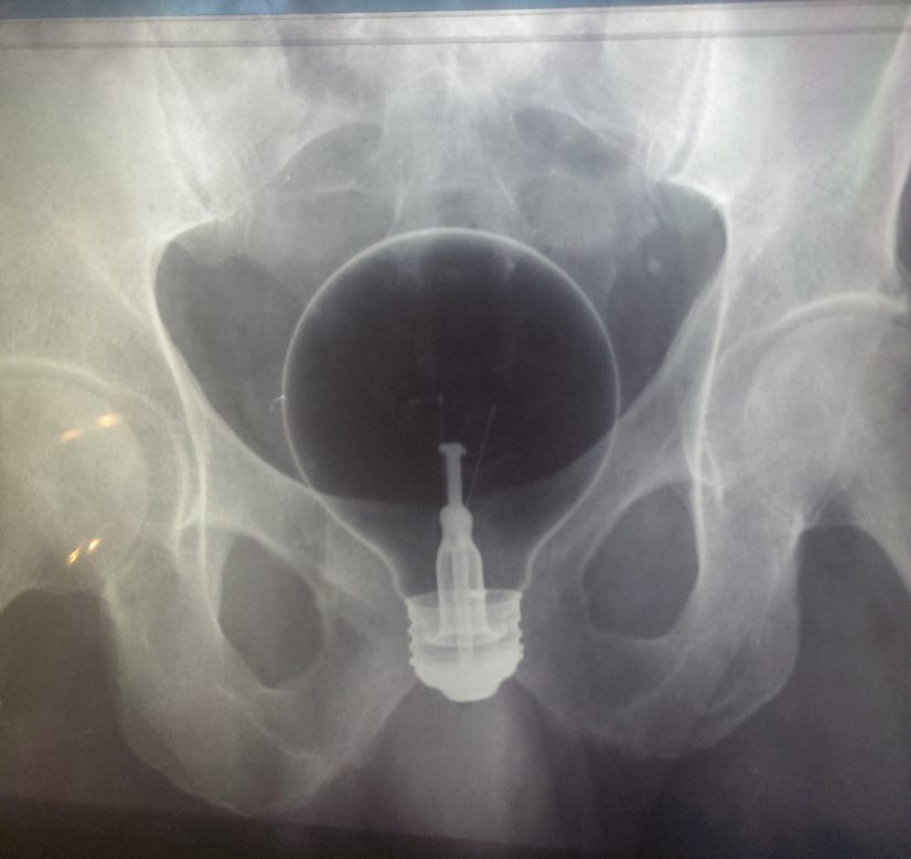 X-Ray of Light Bulb in Butt